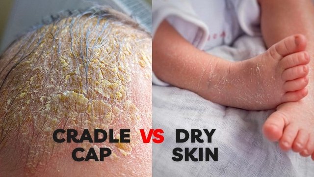 cradle cap vs. dry skin